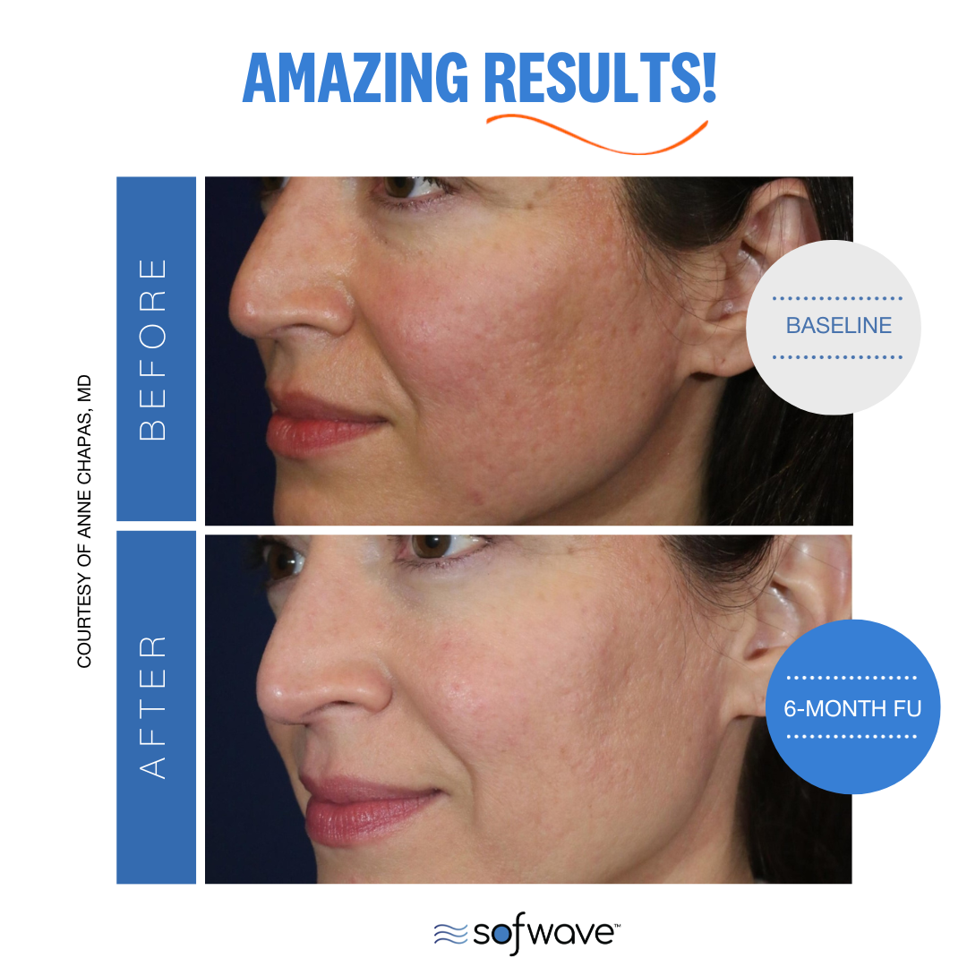 Sofwave™ Acne-Scar Treatment